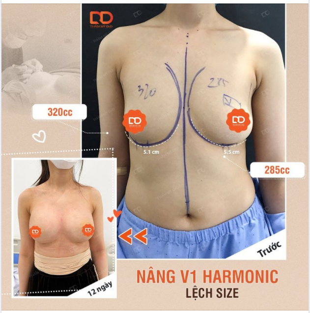 NÂNG NGỰC LỆCH SIZE CÓ KHÓ KHÔNG