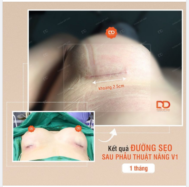Nếu như hỏi Nâng V1 có để lại sẹo không thì DrD xin trả lời rằng là sẽ có sẹo bởi thực hiện phẫu thuật mà.