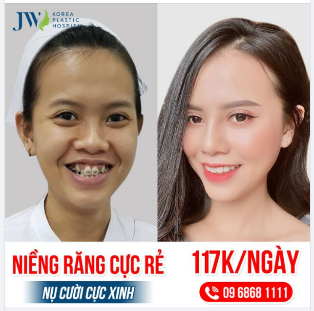 NIỀNG RĂNG THẨM MỸ  NỤ CƯỜI TƯƠI TẮN - NHIỀU ANH SAY NẮNG