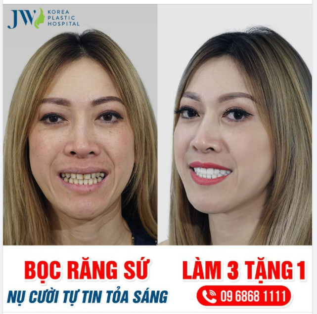 NỮ VIỆT KIỀU VỀ NƯỚC BỌC RĂNG SỨ, BẠN BÈ QUỐC TẾ TRẦM TRỒ KHEN VÌ QUÁ ĐẸP