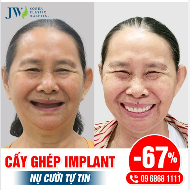 QUÝ BÀ U60 HÀO HỨNG PHỤC HỒI RĂNG VỚI CẤY GHÉP IMPLANT