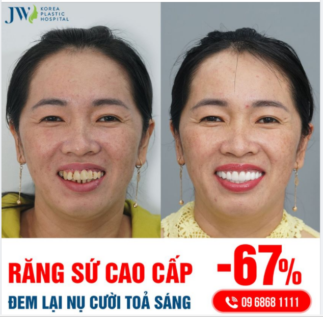 RĂNG SỨ CAO CẤP – ĐEM LẠI NỤ CƯỜI TOẢ SÁNG