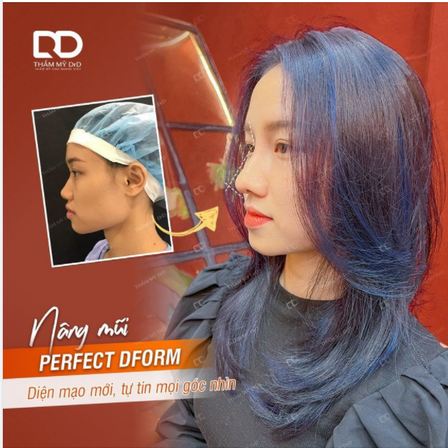 Sẵn sàng tự tin mọi góc nhìn sau Nâng mũi Perfect Dform