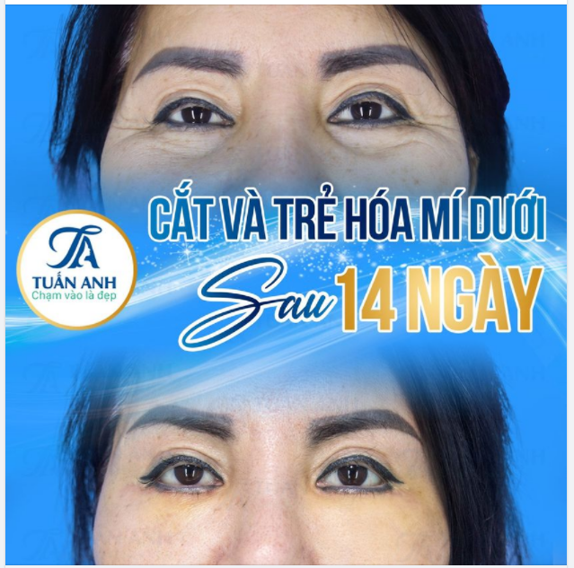 SIÊU CẮT MÍ - Phương pháp trẻ hóa mí mắt độc quyền tại Thẩm Mỹ Tuấn Anh