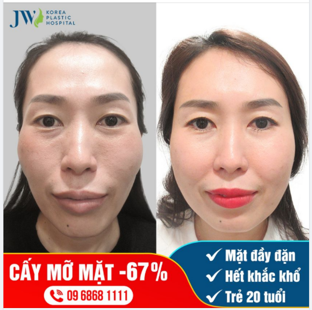 SỢ GIÀ KHẮC KHỔ CẤY MỠ MẶT ĐI TRẺ RA 20 TUỔI!