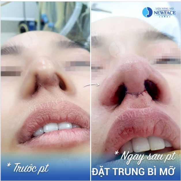 TÁI TẠO ĐẦU MŨI HỎNG TRONG MỘT CA TRUNG BÌ MỠ