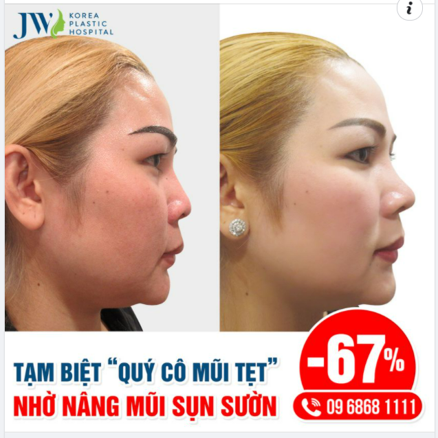 TẠM BIỆT “QUÝ CÔ MŨI TẸT” NHỜ NÂNG MŨI SỤN SƯỜN