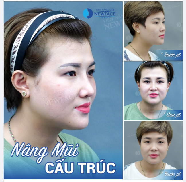 TĂNG ĐIỂM NỮ TÍNH NHỜ NÂNG MŨI CẤU TRÚC