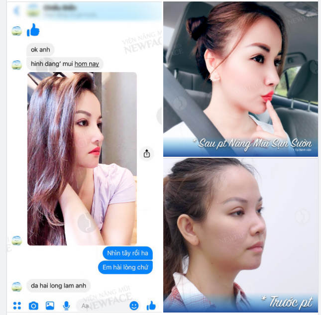THẦN THÁI SIÊU “XỊN” SAU NÂNG MŨI SỤN SƯỜN