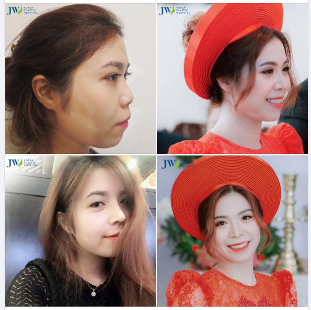 THẬT BẤT NGỜ HOTGIRL ĐẠI HỌC HỒNG BÀNG NHỜ NÂNG MŨI S LINE NAY ĐÃ THEO CHỒNG VỀ DINH