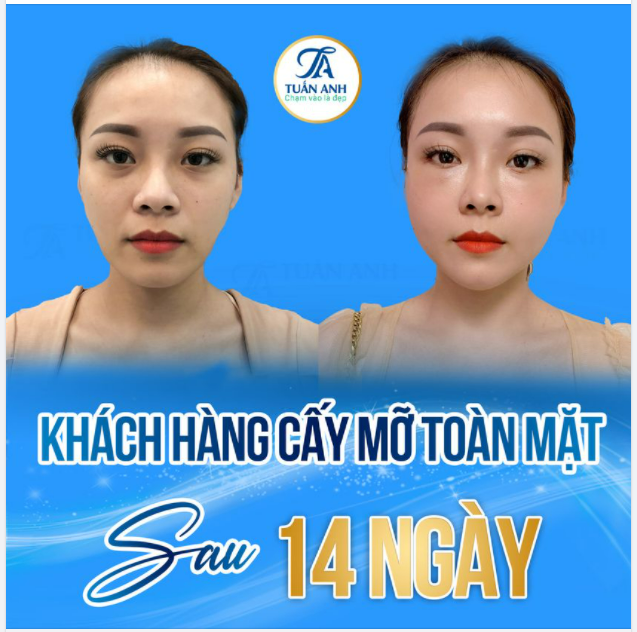 TRẺ RA 10 TUỔI SAU 60 PHÚT với Công nghệ Nano - Tái sinh đa tầng và trẻ hóa toàn diện khắc phục những nét già nua trên khuôn mặt bằng mỡ tự thân sau bao lâu thì hồi phục