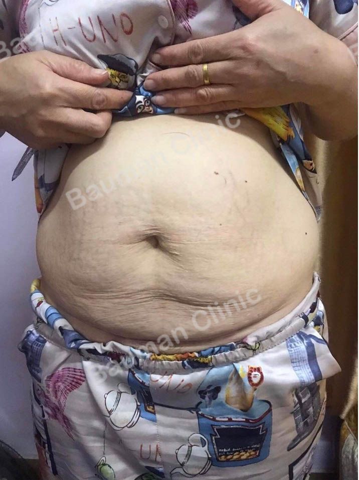 Chị gái 37 tuổi Hải Phòng lên Hà Nội làm tạo hình thành bụng