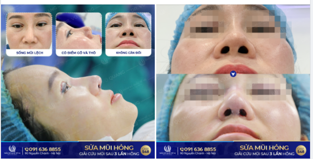 3 lần sửa mũi hỏng và cuối cùng cũng tìm được chân ái