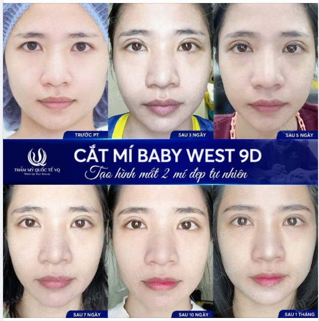 ​​​​​​​3 Lưu ý trước khi quyết định phẫu thuật cắt mí