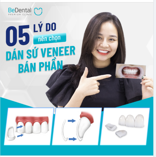 5 LÝ DO NÊN CHỌN DÁN SỨ VENEER BÁN PHẦN