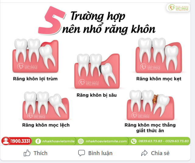 5 TRƯỜNG HỢP NÊN N.HỔ RĂNG KHÔN