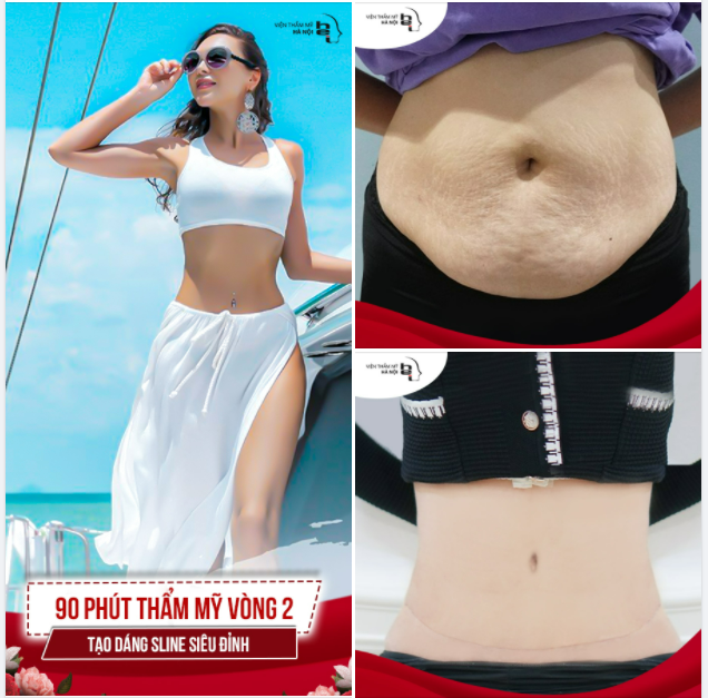 90 THẨM MỸ VÒNG 2 - TẠO DÁNG SLINE SIÊU ĐỈNH