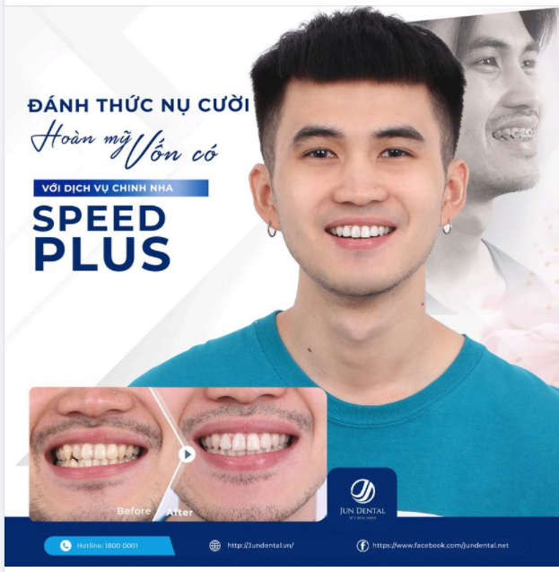 Ad vẫn nhớ ngày đầu tiên Đội ngũ Jun Dental gặp anh Đình Công, với khá hiều vấn đề về răng miệng anh đang gặp phải.