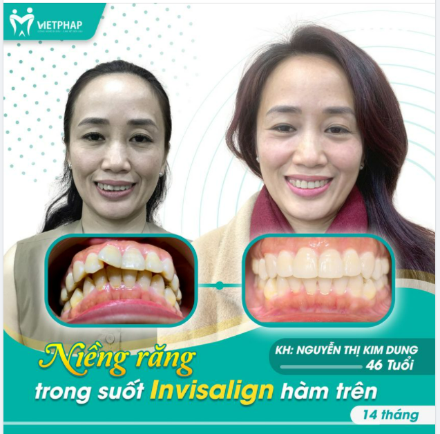 AI NÓI U50 KHÔNG NIỀNG RĂNG ĐƯỢC AI NÓI U50 NIỀNG RĂNG THÌ SẼ LÂU LẮM