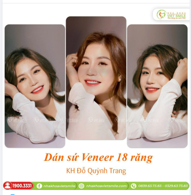 AN TÂM THAY ÁO MỚI CHO NỤ CƯỜI VỚI MIẾNG DÁN SỨ VENEER