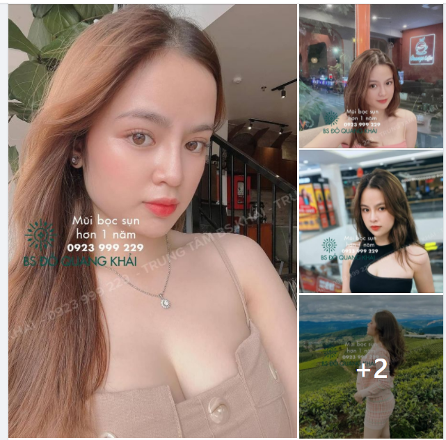 BÁC SĨ KHẢI GỬI CE FEEBACK MŨI BỌC SỤN HƠN 1 NĂM