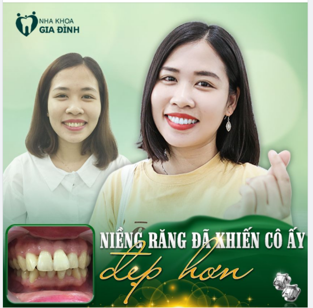 Bạn có biết răng niềng răng là một phương pháp có thể khiến khuôn mặt bạn thay đổi trở nên xinh đẹp hơn không