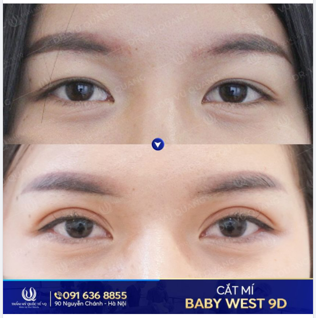 Bạn đang tìm hiểu về cắt mí thì nhất định phải xem bài viết này.