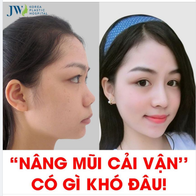 BẤT NGỜ CHƯA! MŨI CAO S LINE - TIỀN VÀO ÀO ÀO