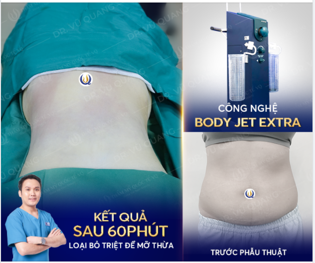 Béo bung. không chỉ khiến ngoại hình mất cân đối mà còn tiềm ẩn nguy cơ mắc nhiều bệnh lý nguy hiểm.