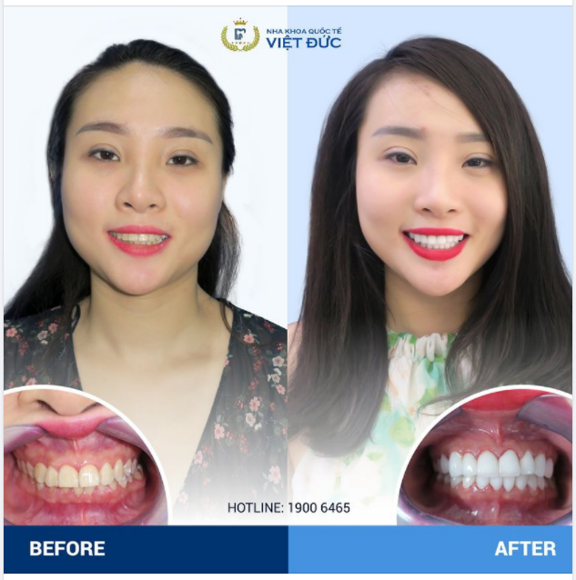 BIẾN HÓA NỤ CƯỜI CÙNG RĂNG SỨ EMAX