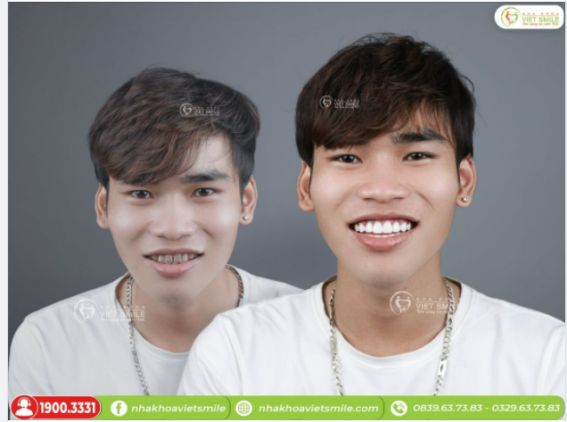 BỌC RĂNG SỨ KHẮC PHỤC RĂNG NHIỄM KHÁNG SINH ĐỘ 3