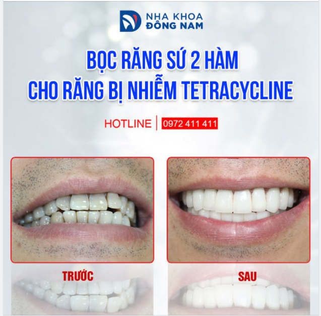 BỌC RĂNG SỨ TRỊ RĂNG NHIỄM TETRACYCLINE, ĐEN SẪM TỪ GỐC