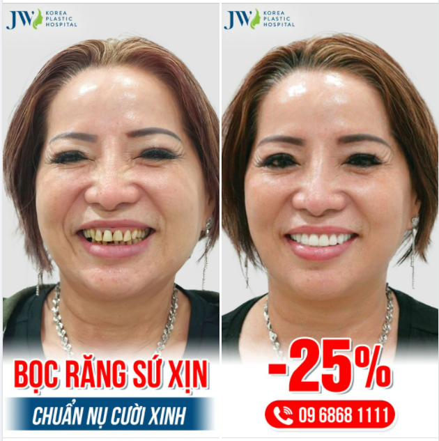 BỌC RĂNG SỨ XỊN - CHUẨN NỤ CƯỜI XINH