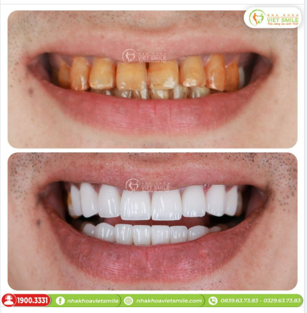 BỌC SỨ 16R NACERA ĐA LỚP - KHẮC PHỤC RĂNG NHIỄM MÀU NẶNG