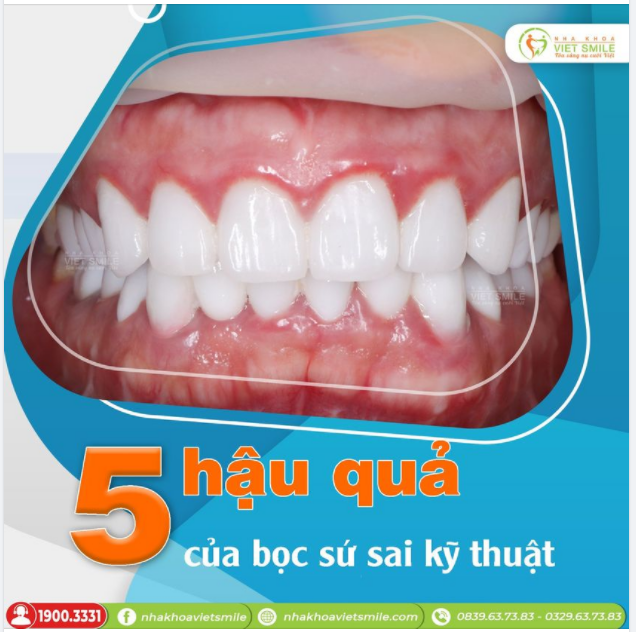 BỌC SỨ SAI KỸ THUẬT GÂY RA HẬU QUẢ GÌ