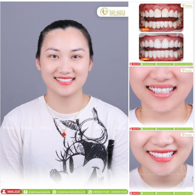 BỌC SỨ THẨM MỸ 16R LAVA PLUS THỦ CÔNG - GIẢI CỨU THÀNH CÔNG SỨ HỎNG