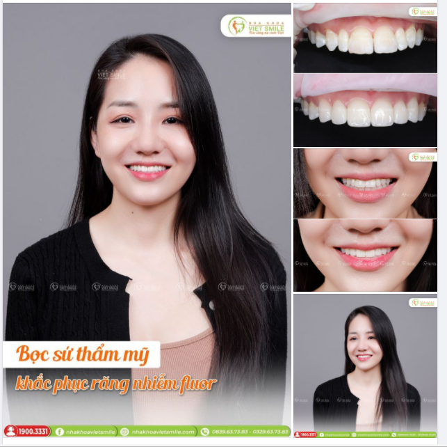 BỌC SỨ THẨM MỸ KHẮC PHỤC RĂNG NHIỄM FLUOR
