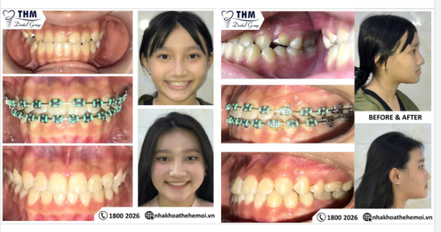 CA LÂM SÀNG Niengrang THÀNH CÔNG CHO KHÁCH HÀNG KHỚP CẮN NGƯỢC TẠI nhakhoathehemoi 