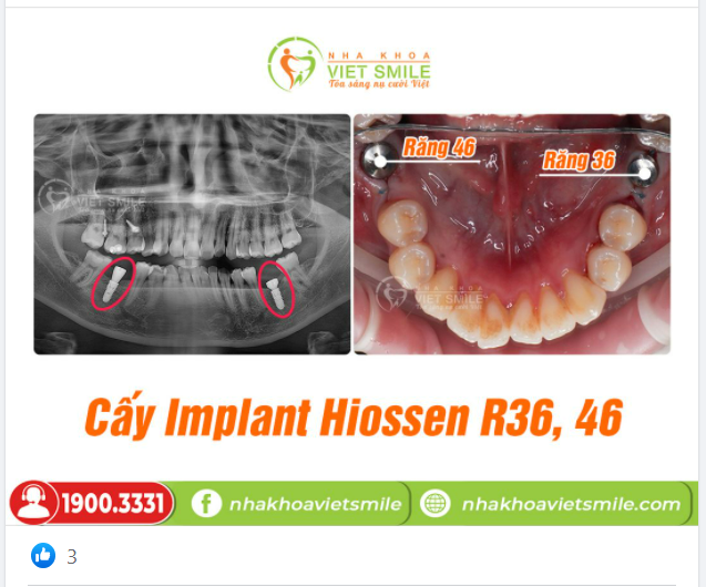 CẤ.Y IMPLANT HIOSSEN RĂNG HÀM 36,46
