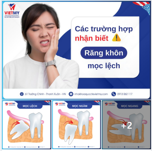 CÁC TRƯỜNG HỢP NHẬN BIẾT RĂNG KHÔN MỌC LỆCH