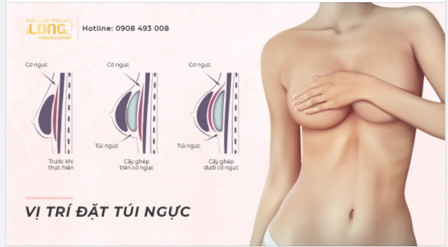 CÁC VỊ TRÍ ĐẶT TÚI KHI NÂNG VÒNG 1
