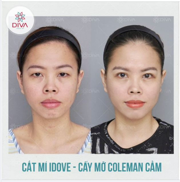 CẢI THIỆN CẰM LẸM, MÍ LÓT, MẮT NHỎ - GƯƠNG MẶT TƯƠI TRẺ, THU HÚT SAU THẨM MỸ