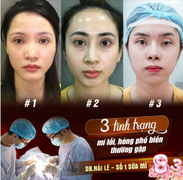 CẢNH BÁO 3 TÌNH TRẠNG MÍ LỖI, HỎNG PHỔ BIẾN THƯỜNG GẶP