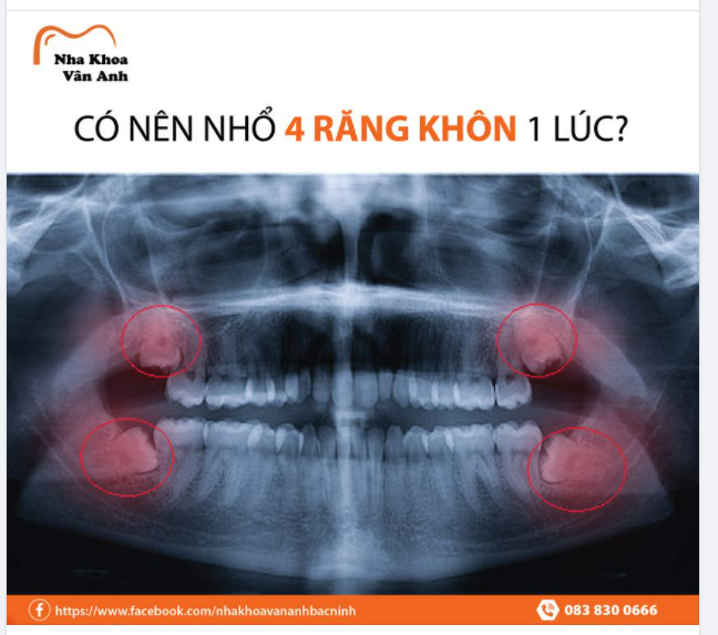 (CẢNH BÁO NHỔ RĂNG KHÔN) KHÔNG NÊN NHỔ 4 RĂNG CÙNG 1 LÚC