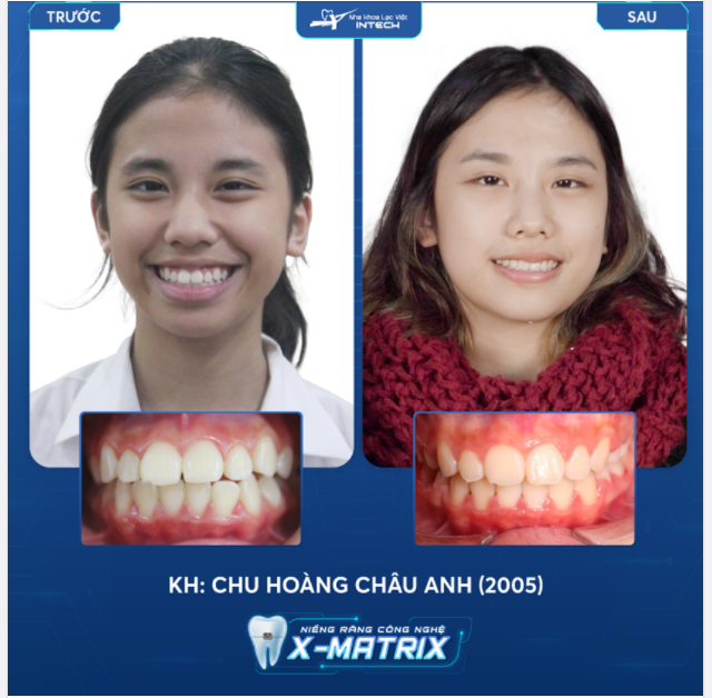 CASE 51  KHẮC PHỤC HÔ, KHẤP KHỂNH BẰNG CÔNG NGHỆ X-MATRIX