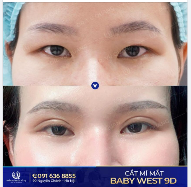 Cắt Mí Baby West 9D áp dụng cho những trường hợp nào