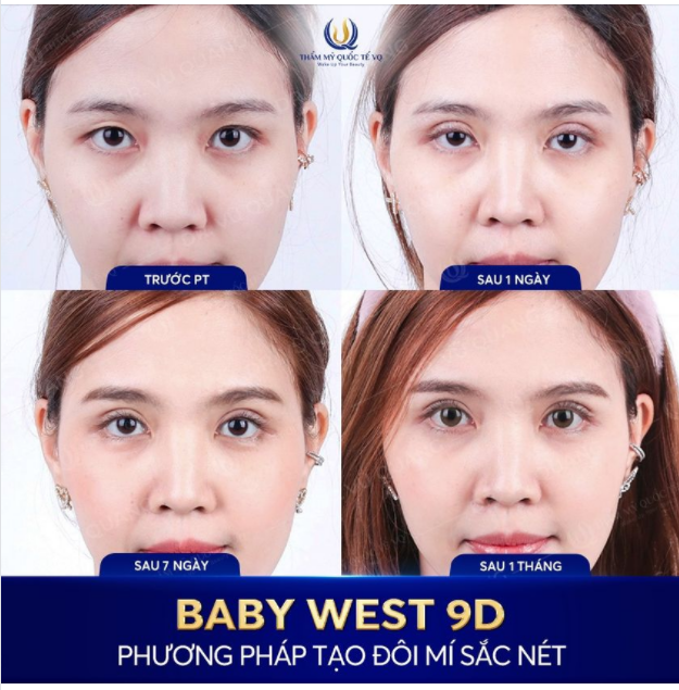 Cắt mí duy trì được bao lâu  Có được vĩnh viễn không