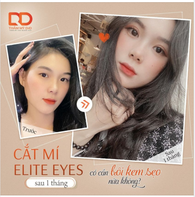 Cắt mí Elite Eyes Rút ngắn thời gian bôi kem chống sẹo