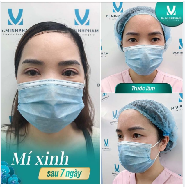 CẮT MÍ KHÔNG ĐƠN GIẢN NHƯ NHIỀU NGƯỜI NGHĨ!