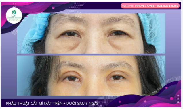 Cắt mí mắt ở người lớn tuổi khi thẩm mỹ cũng là điều